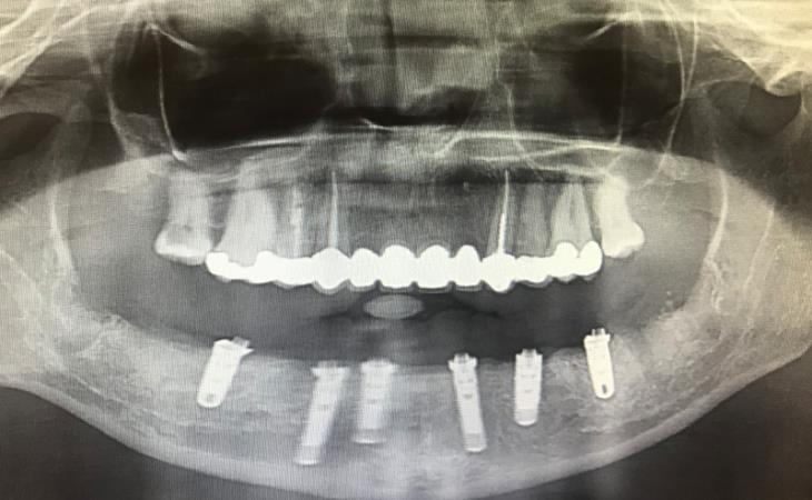 After Dental Implant Procedure