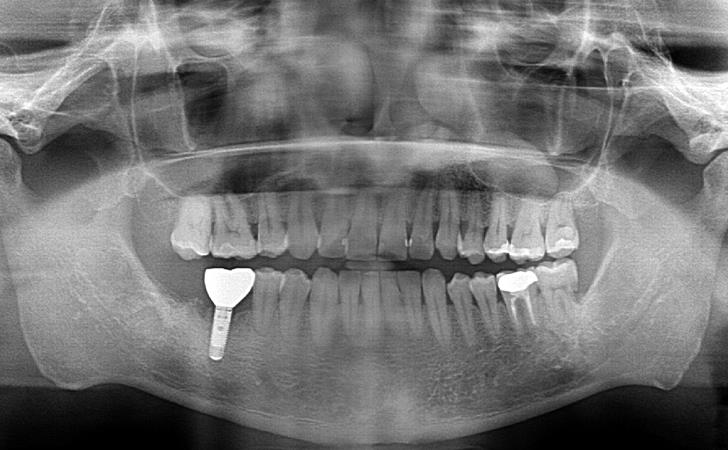 Dental Implants After Image