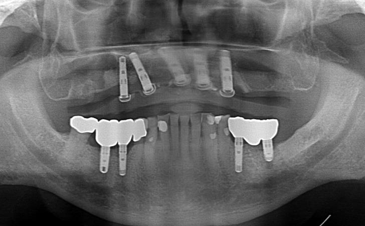 Dental Implants Surgery After Image