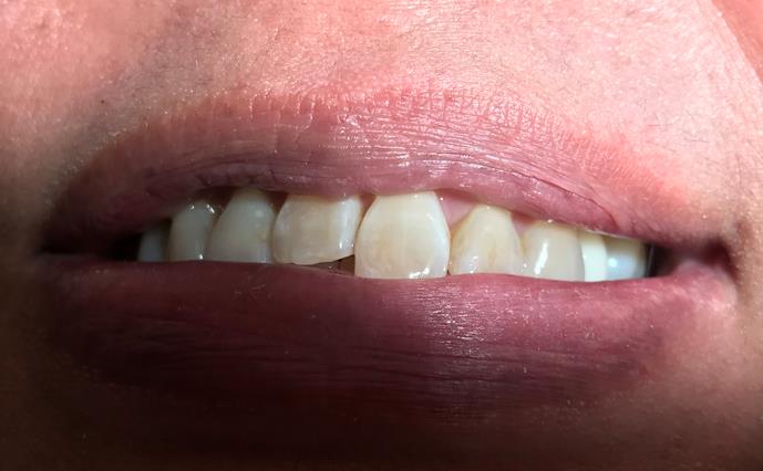 After Tooth Replacement