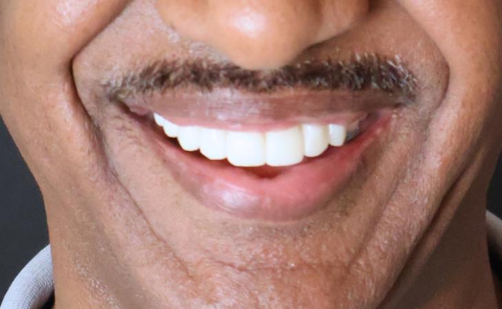 After Dental Implants
