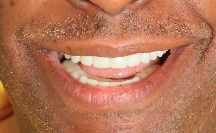 After Dental Implants