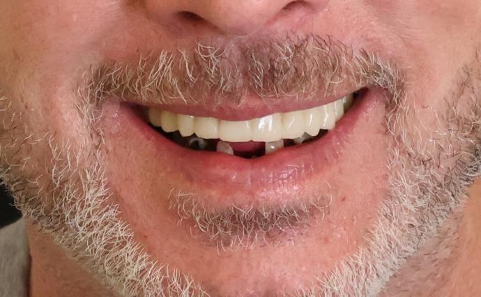 After Dental Implants