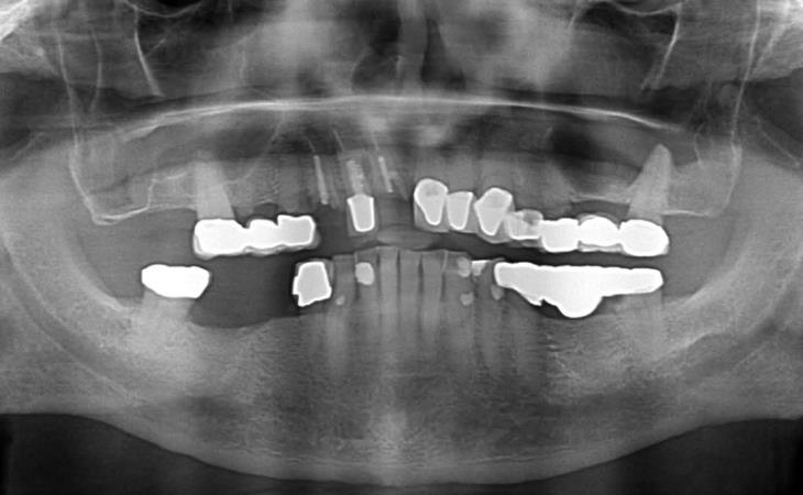 Before Dental Implants Surgery