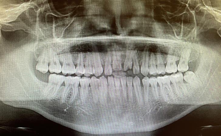 Before Dental Implants Procedure