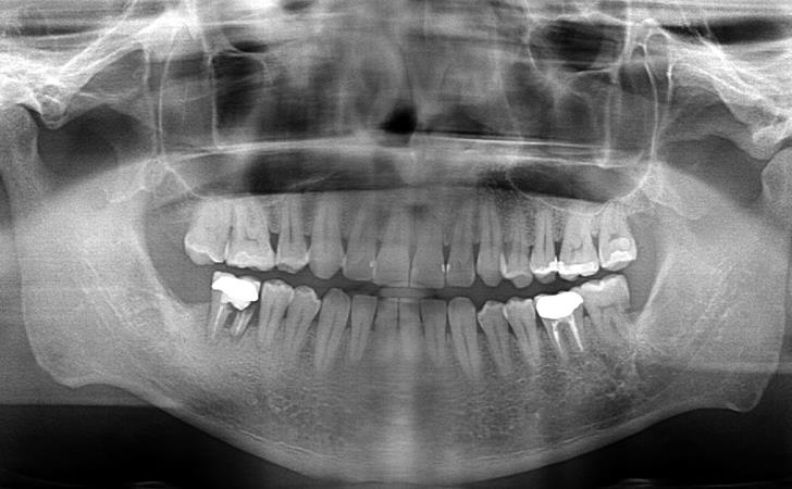 Dental Implants Before Image