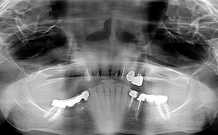 Dental Implant Before Image