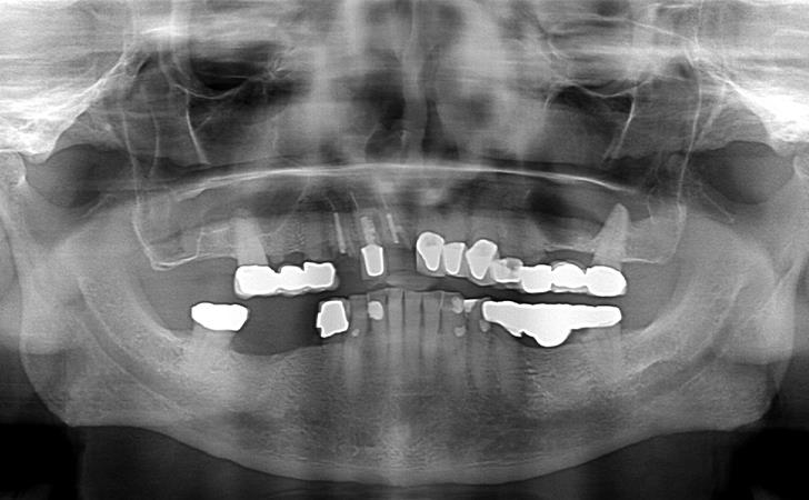 Dental Implants Surgery Before Image