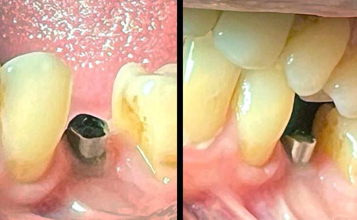 Before Dental Implant