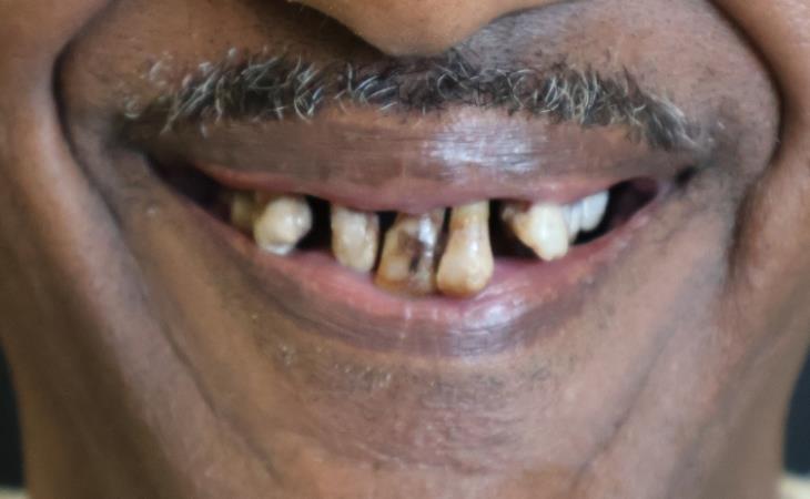 Before Dental Implants