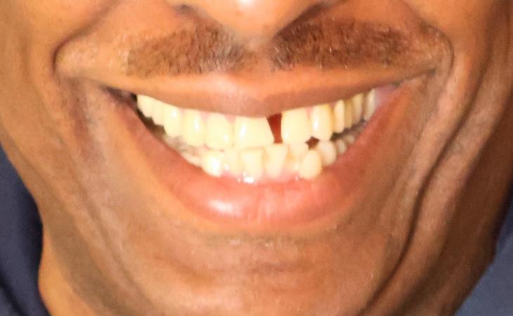 Before Dental Implants