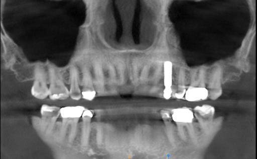 Implant Placed Too Buccal, Buccal Bone Resorbing Away