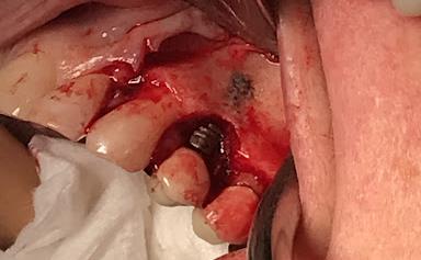 Infected Implant Image