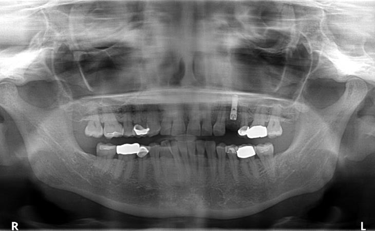 Implant X-Ray Image