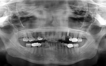 Implant X-Ray Photo