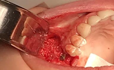 Bone Grafting And Closure Of Site