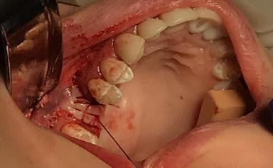 Bone Grafting And Closure Of Site Image