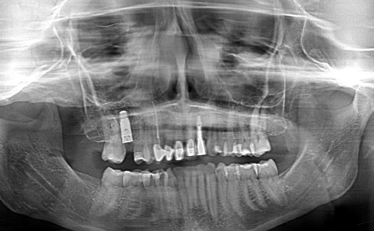 Extraction Implant Placement At Site #3 With Bone Graft