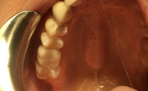 Crown Placement At Implant Site #3