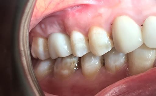 Crown Placement At Implant Site #3 Image