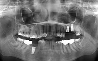 Implant Placement Image