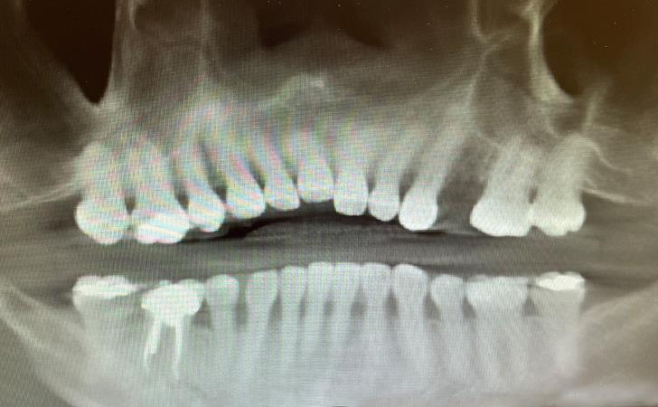 Before Tooth Replacement Surgery