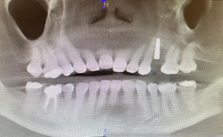 After Tooth Replacement Surgery