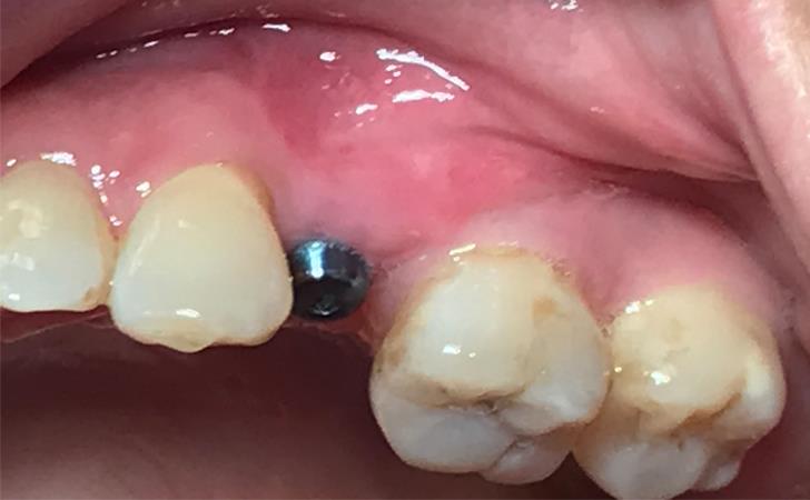 Tooth Replacement Results