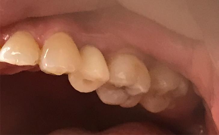 Tooth Replacement Surgery Results