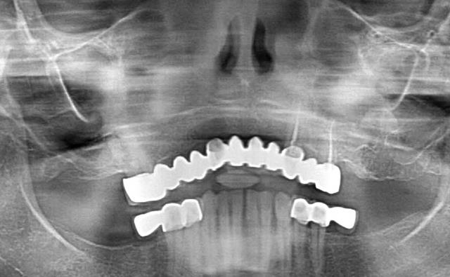 Before Treatment X-Ray