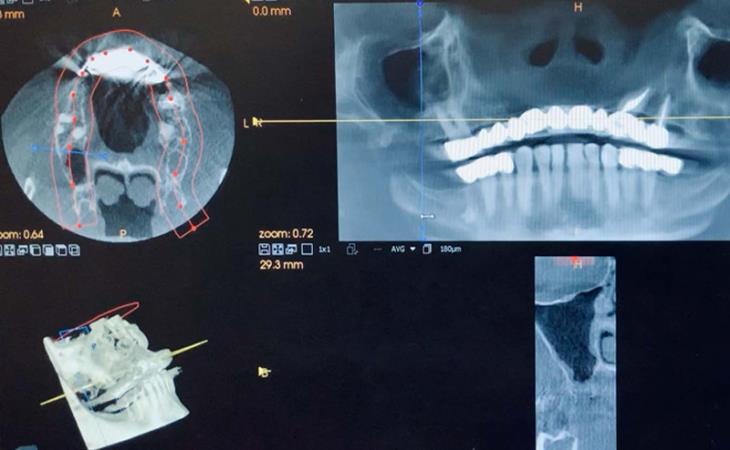 Before Cone Beam Analysis