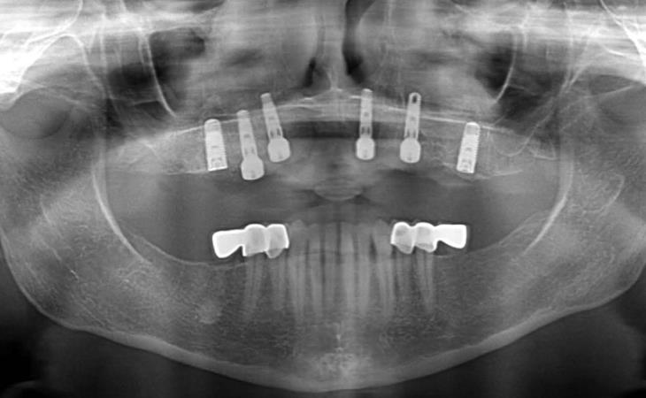 After Treatment X-Ray