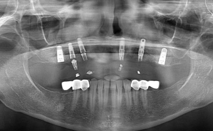 After Treatment X-Ray Image