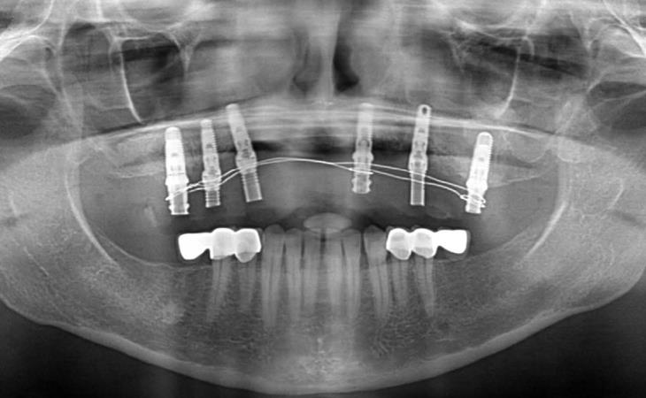 After Treatment X-Ray Photo