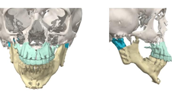 preoperative vsp