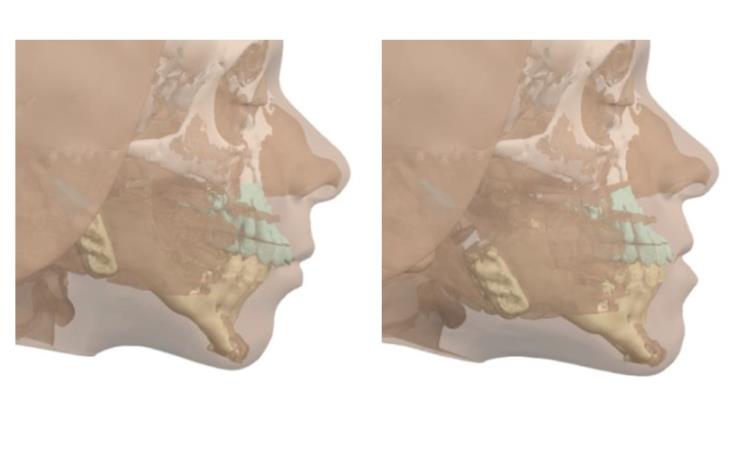 preoperative vsp