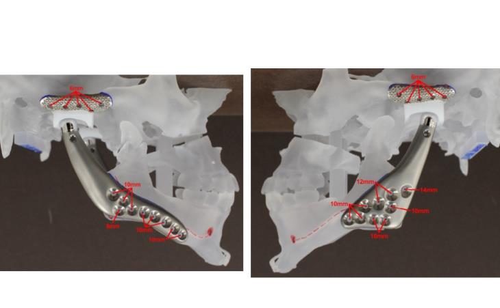 STL Model with Custom TMJ Prosthesis