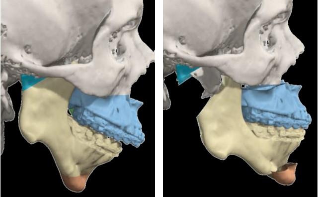 Preoperative vs Postoperative