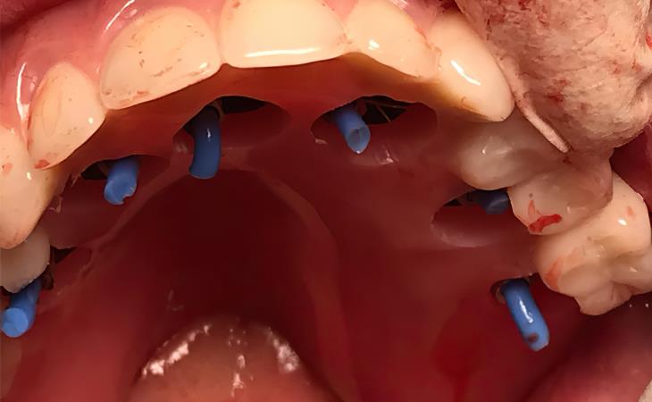 During Full Mouth Reconstruction