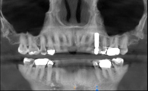 Replacing One Tooth Surgery