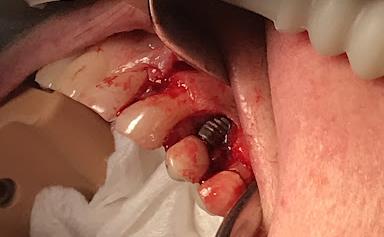 Infected Implant