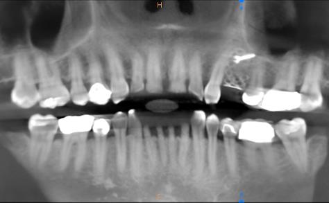 Dental X-ray