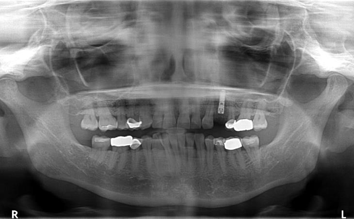 Dental X-ray Image