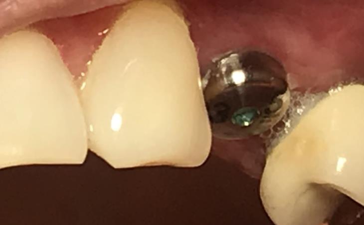 Uncovering Healing Abutment