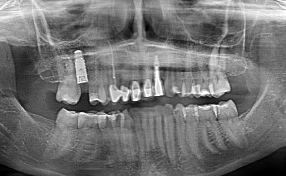 Implant Replacement