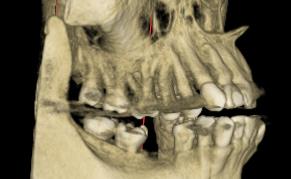 Bone Graft X-Ray