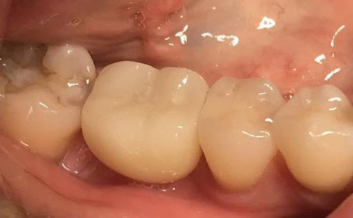 One Tooth Restoration