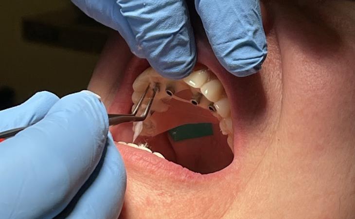 Tooth Restoration Procedure Image