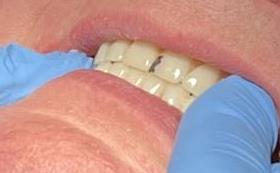 Tooth Restoration Procedure
