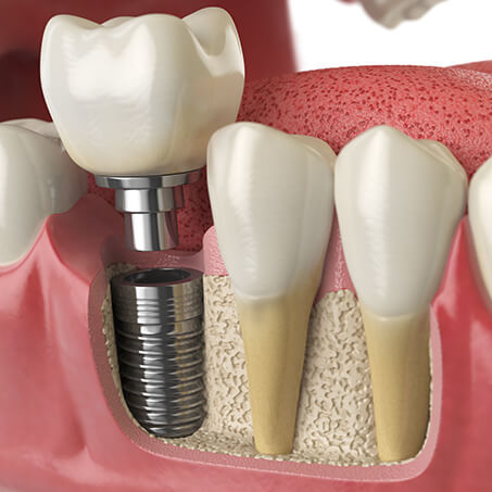 Single Tooth Replacement